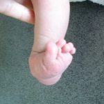 Pied Calcaneus